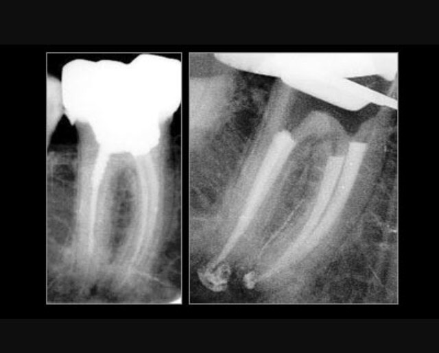 dentiste Ormesson La Varenne Saint-Hilaire endodontique