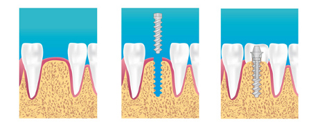 implant dentaire ormesson la varenne saint hilaire implant dentaire ormesson la varenne saint hilaire