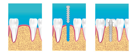 implant dentaire ormesson la varenne saint hilaire