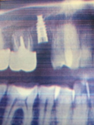 radio implant dentaire ormesson la varenne saint hilaire